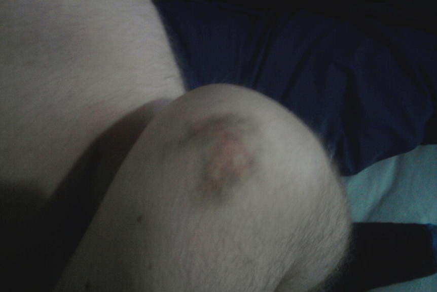 Brandon Moore's bruised knee