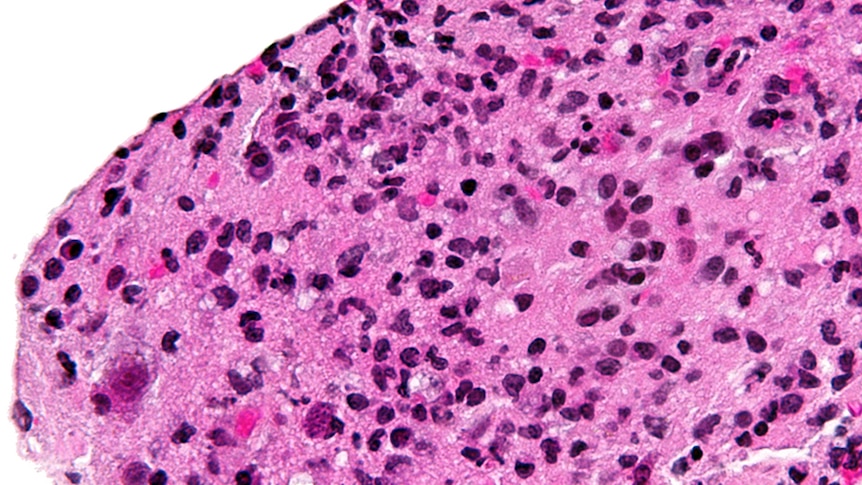 Toxoplasmosis indicated in a brain biopsy