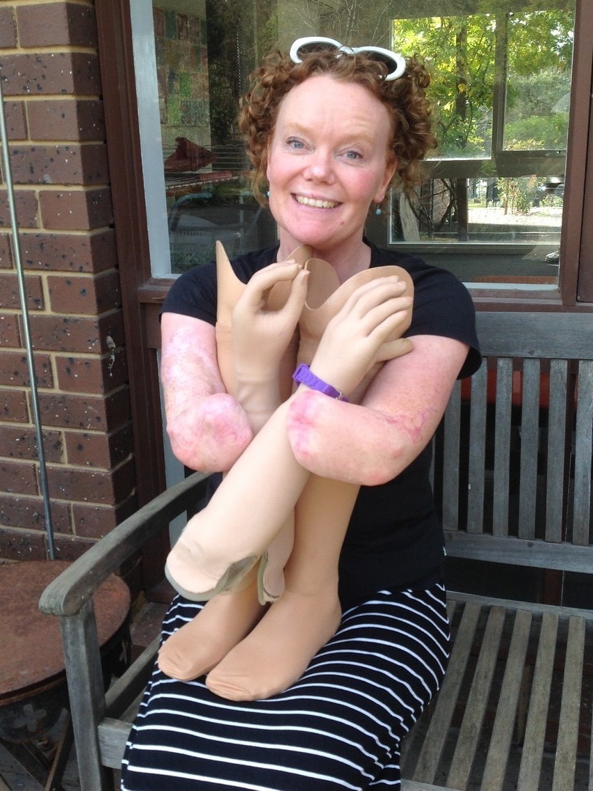 A woman with no hands sits holding prosthetic arms and legs.