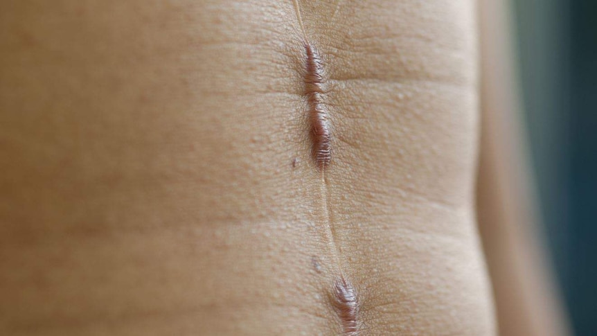 Close up of a scar