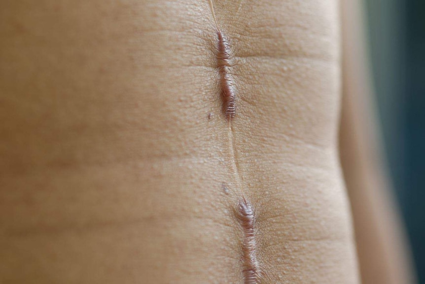 Close up of a scar