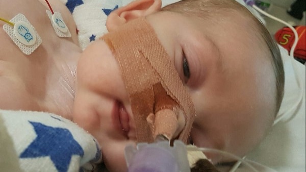 Baby Charlie lies in a hospital bed with his eyes slightly open with a ventilator strapped to his face.