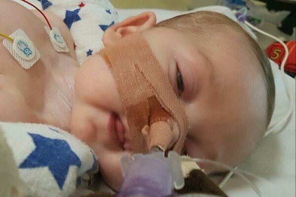Baby Charlie lies in a hospital bed with his eyes slightly open with a ventilator strapped to his face.