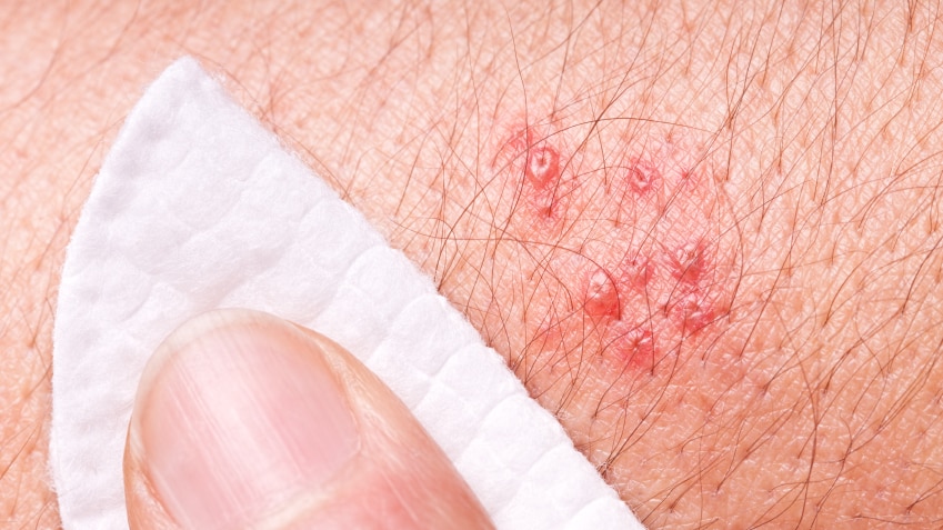 A person with an outbreak of shingles