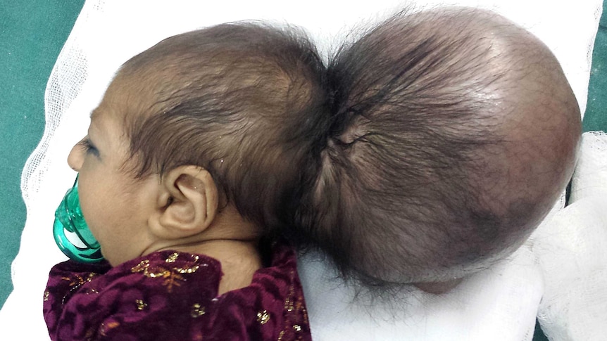 Afghan baby born with extra head
