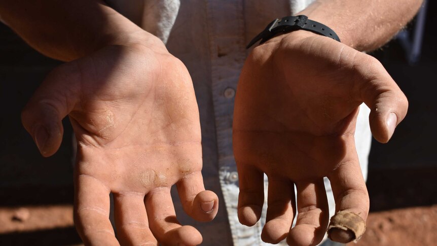 Two callus-riddled hands face the camera, showing the impacts of hard physical work.