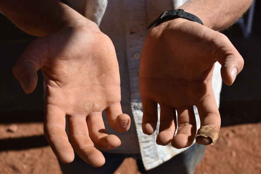 Two callus-riddled hands face the camera, showing the impacts of hard physical work.