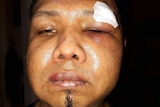 A headshot of Thaksin 'Sin' Monthonthaksin shows his bruised eye and seven stitches as a result of the fight.