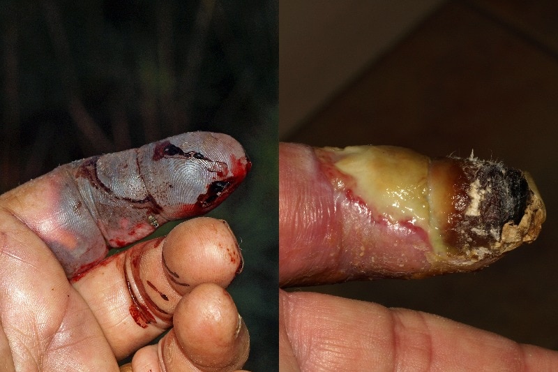 Brian Bush's injured finger 3 days and 35 days after being bitten by a mulga snake