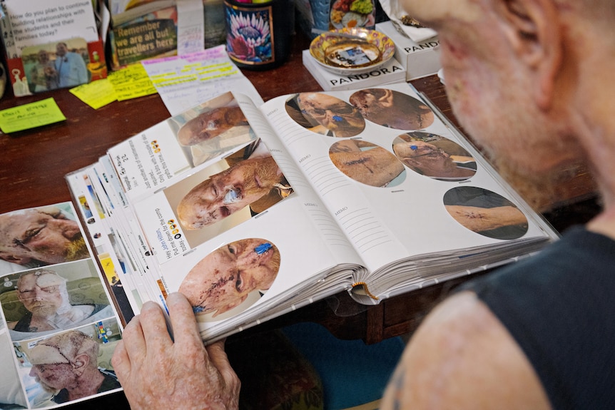 A man looks at a photo album of his journey with skin cancer. 