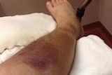 An early-stage necrotising fasciitis infection on a man's leg.