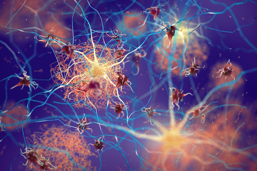 A colourful 3D illustration showing beta-amyloid proteins forming on nerves inside the brain.