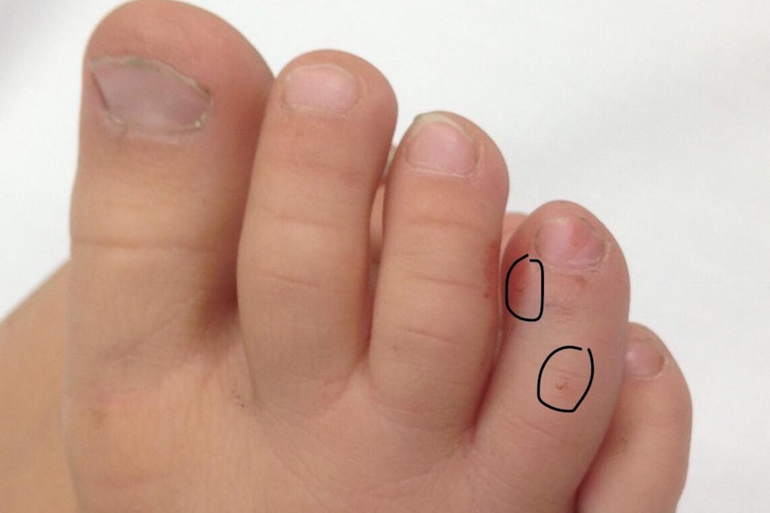 A close of photo of a child's toes showing two tiny puncture wounds, circled.