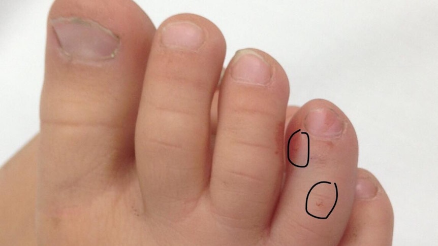 A close of photo of a child's toes showing two tiny puncture wounds, circled.