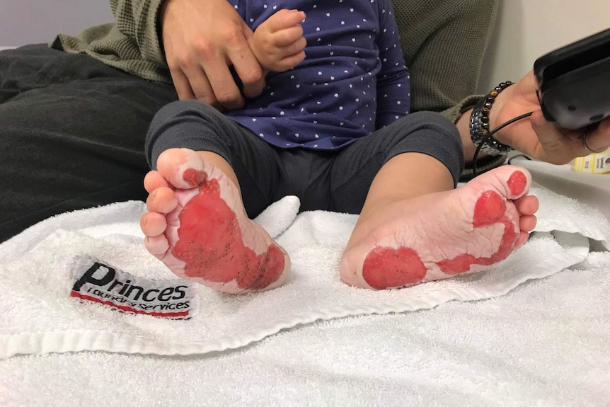 Burns to the souls of a toddler's feet