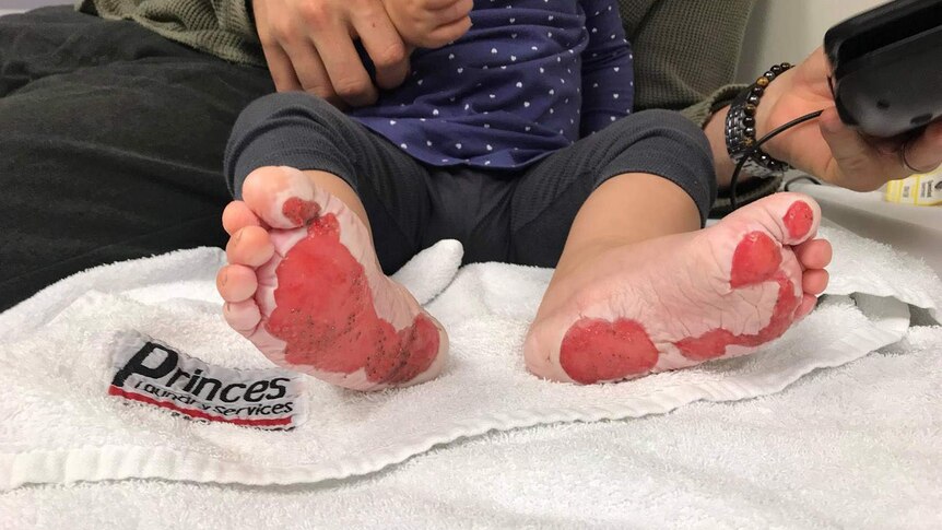 Burns to the souls of a toddler's feet