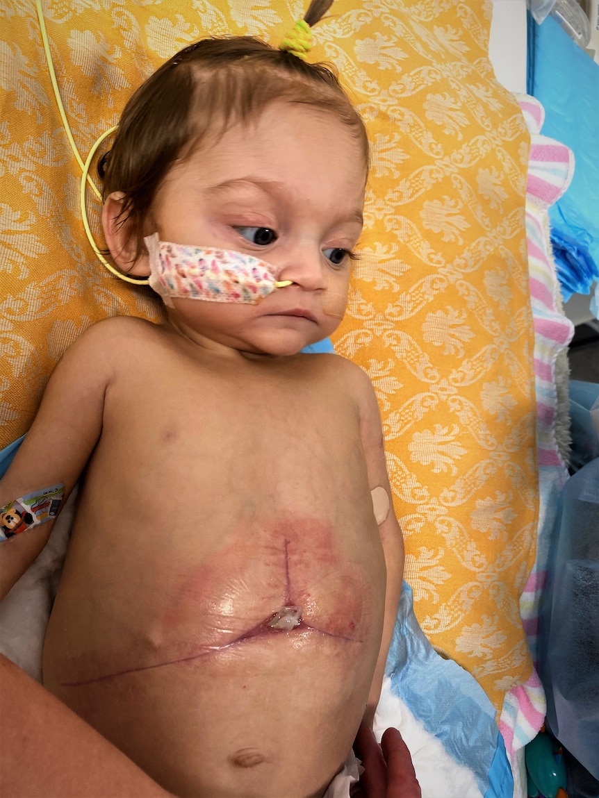 Infant with a huge star-shaped scar on her abdomen.