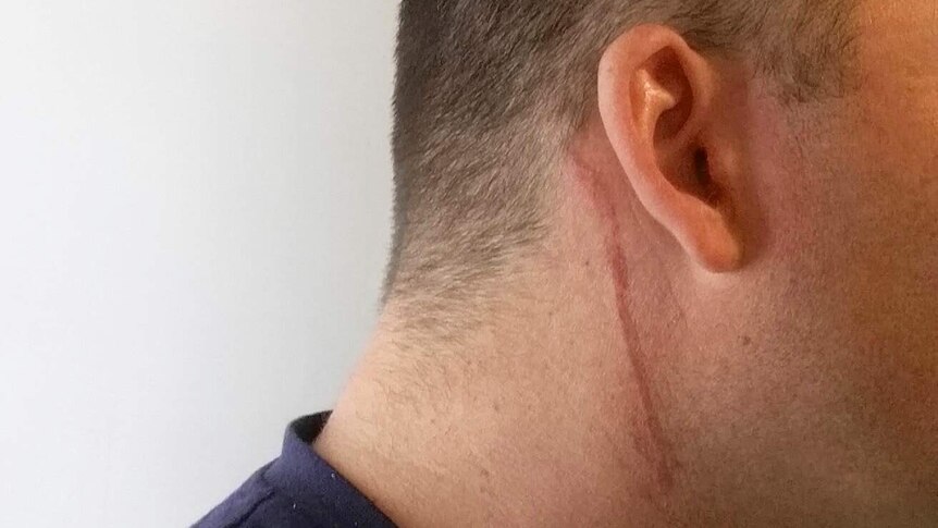 A photo of Paul Gibbons' neck following the incident with police in which he said he was put in a chokehold.
