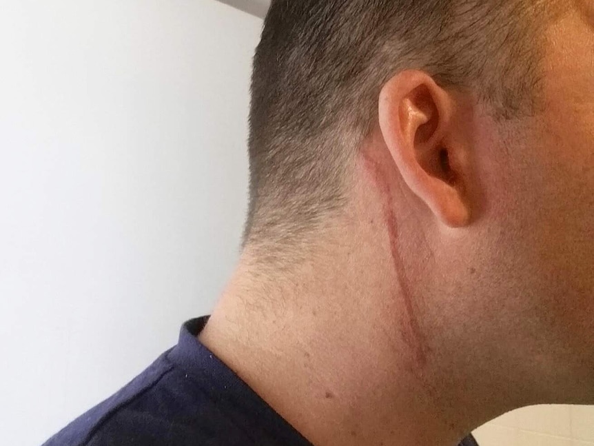 A photo of Paul Gibbons' neck following the incident with police in which he said he was put in a chokehold.
