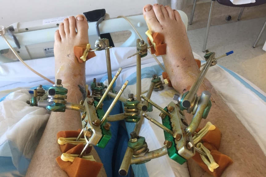 a man's legs covered in surgical clamps in a hospital bed