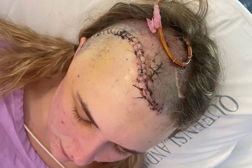 the top of a young woman's shaved head with scar from forehead to behind the ear