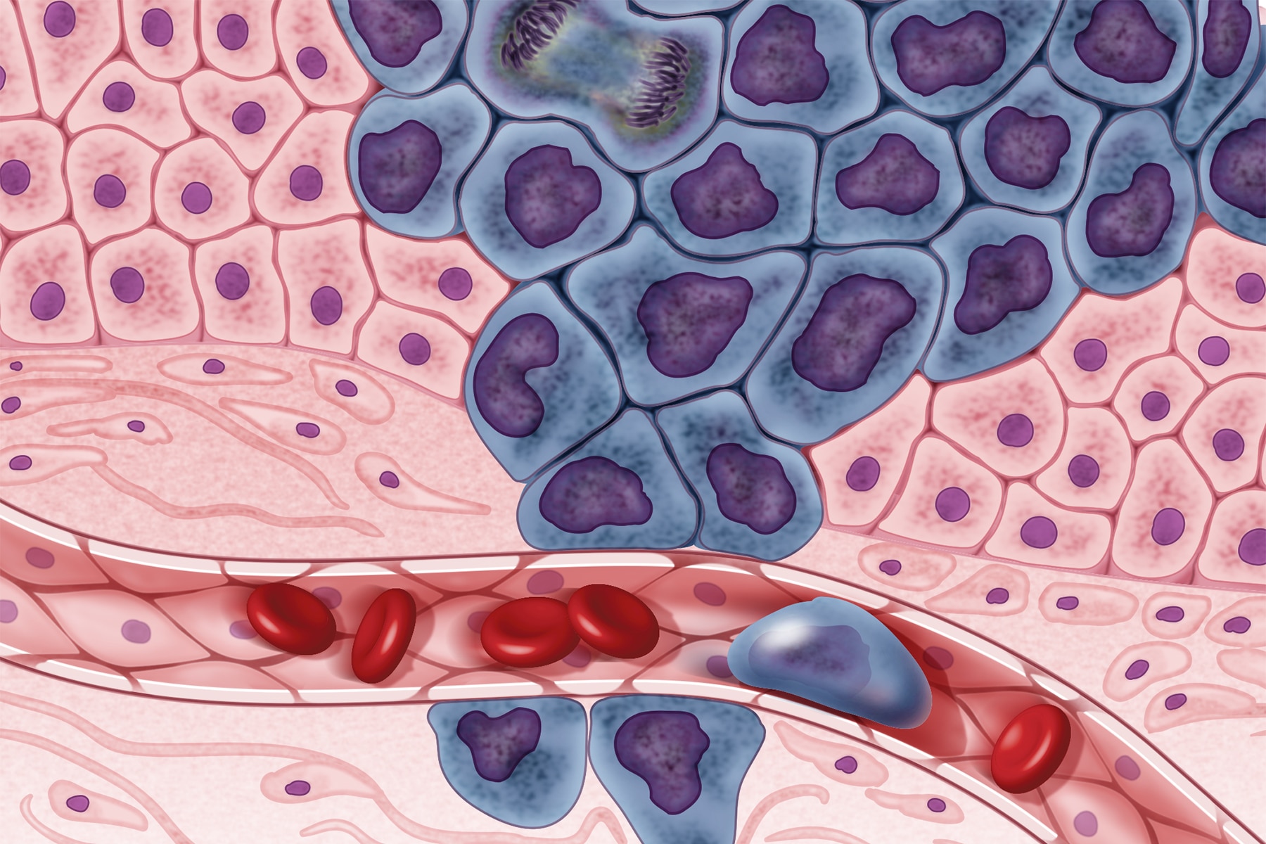 An illustration of cancer cells spreading to other parts of the body via the bloodstream.