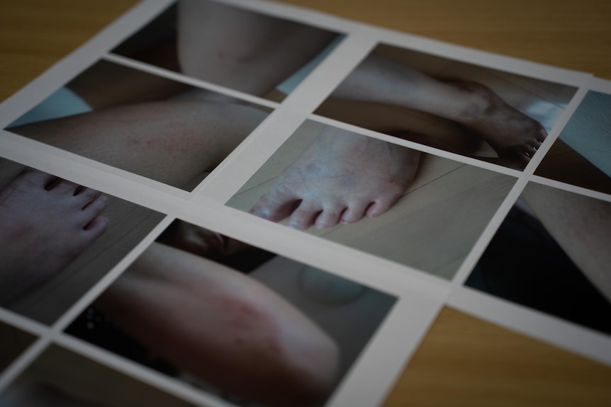 A series of photos showing bruises on feet and other body parts.