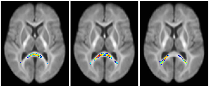 Three images of a brain scanned by an MRI.