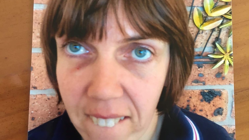 Jane Barnett with a bruise to her right eye
