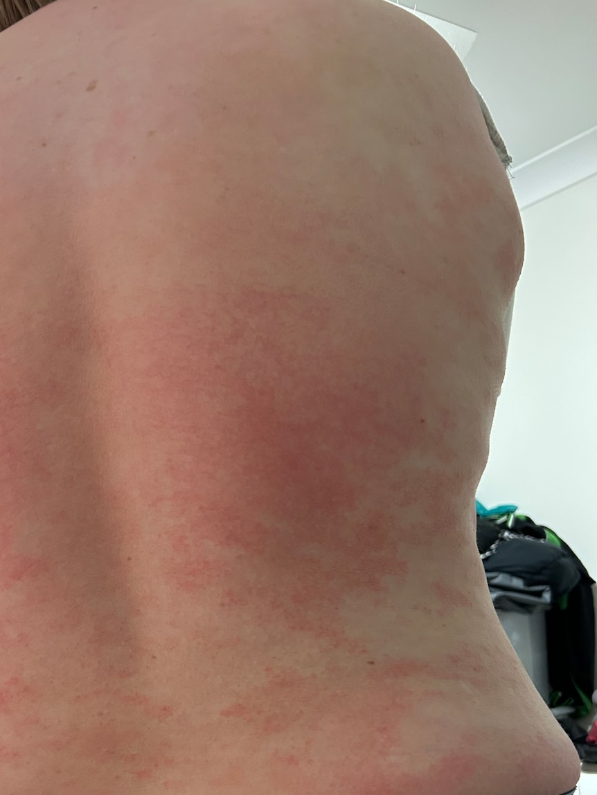 A woman's back with eczema