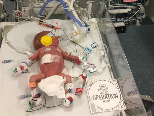 A very tiny baby with many tubes and wires attached as he is prepared for surgery.
