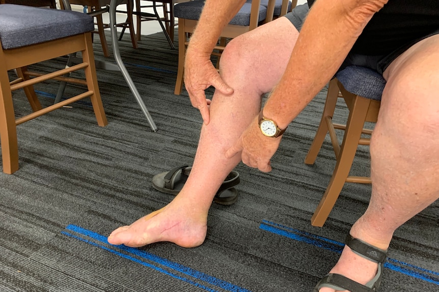 man shows a leg with a scar on it 