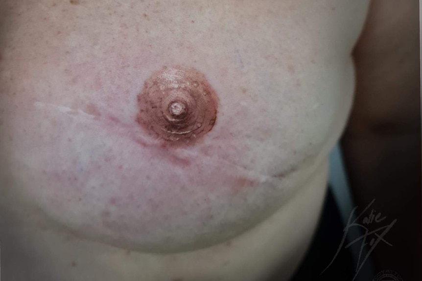 A nipple has been tattooed on to a breast that's undergone a mastectomy, with the scar visible underneath the new nipple.