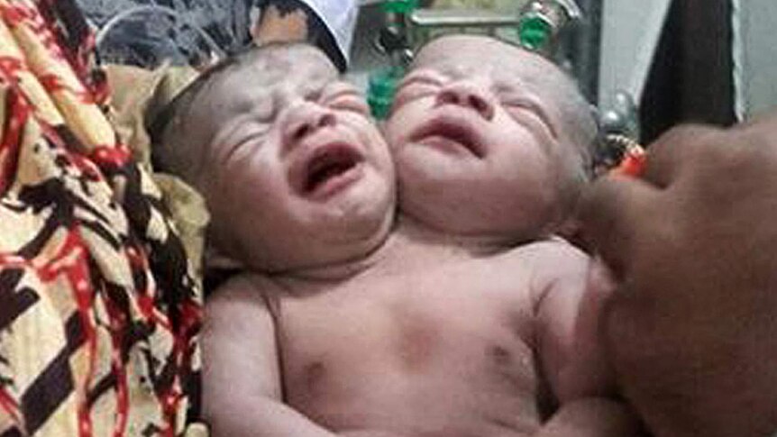 Bangladesh baby girl born with two heads
