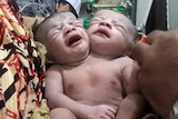 Bangladesh baby girl born with two heads