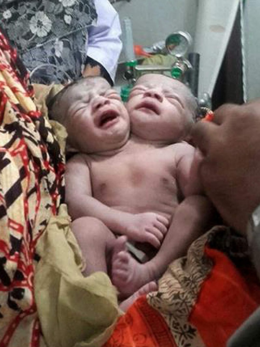 Bangladesh baby girl born with two heads