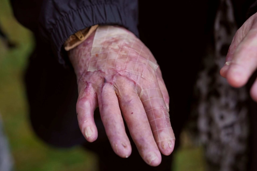 A woman's hands are badly burnt