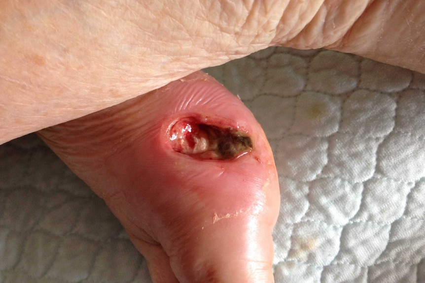 A weeping ulcer on a foot.