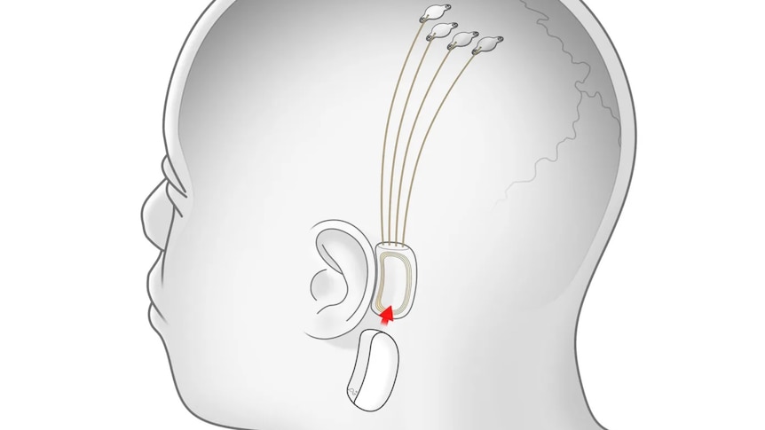 A graphic showing a Neuralink implant.