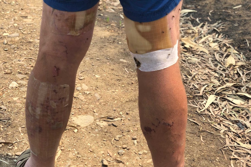 The back of a man's legs, showing burns, blisters and bandages.