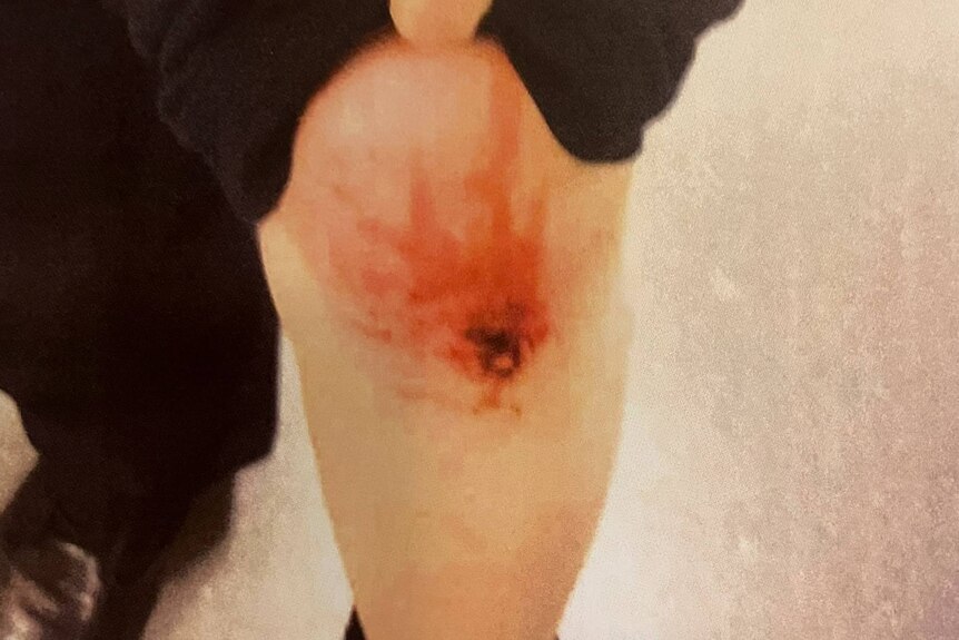 Blood from a cut knee.