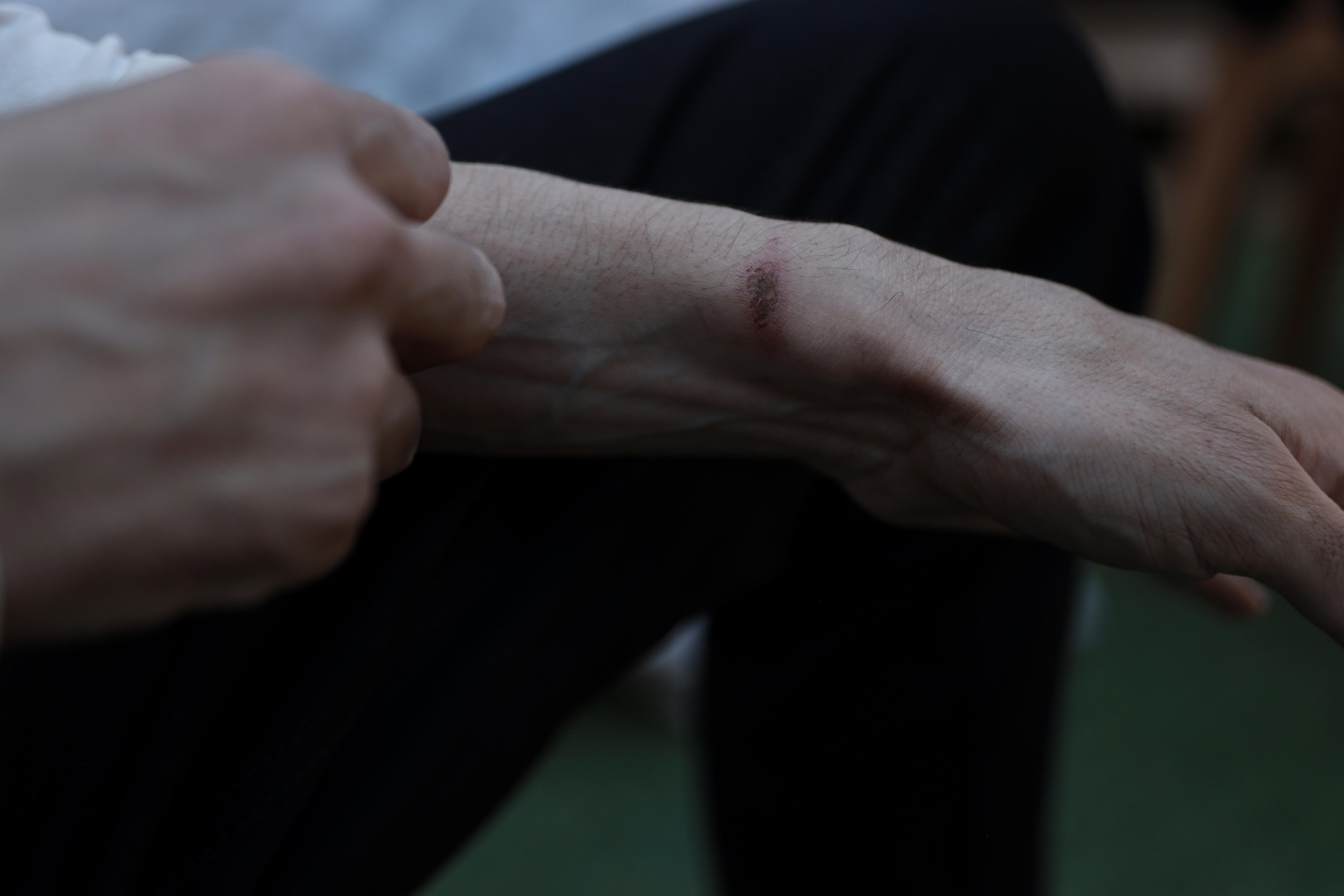 Shadi Abu Sido points to a scar on his wrist.