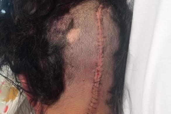 A large scar on the back of the head of a girl with black hair.