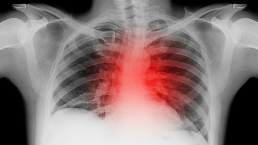 A chest x-ray with a heart mark around where the heart is.