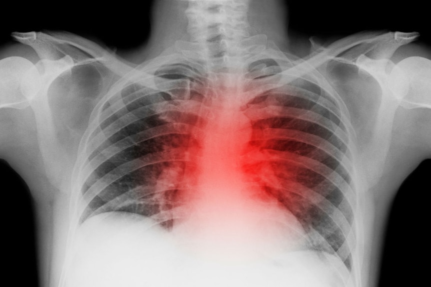 A chest x-ray with a heart mark around where the heart is.