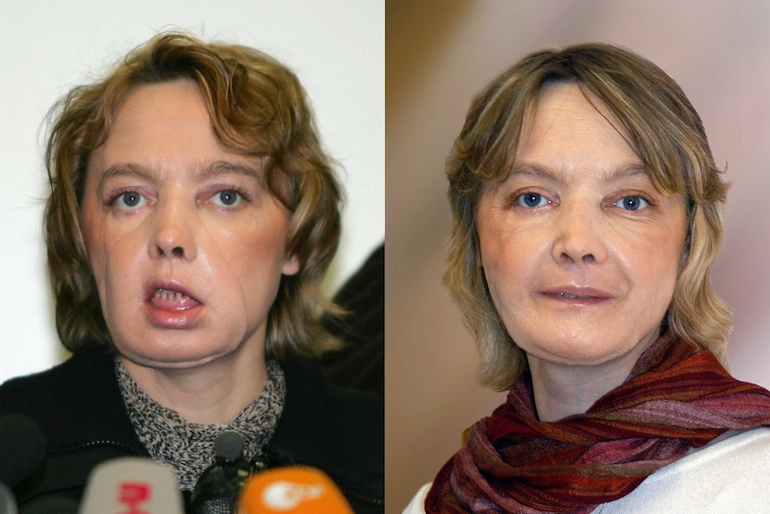 This combination of pictures dated, (L) February 6, 2006 and (R)from November 2006) of French Isabelle Dinoire, 39, a few months after her face transplant surgery.