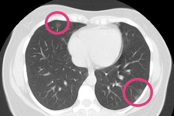 A CT scan of the lungs of an asymptomatic woman with COVID-19 pneumonia.