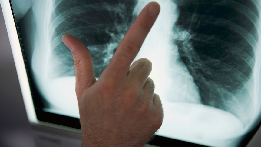 Lung x-ray (Thinkstock:  Digital Vision)