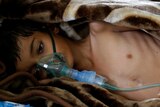 An eight-year-old malnourished boy lies on a bed in the emergency ward of a hospital in Sanaa, Yemen September 27, 2016.