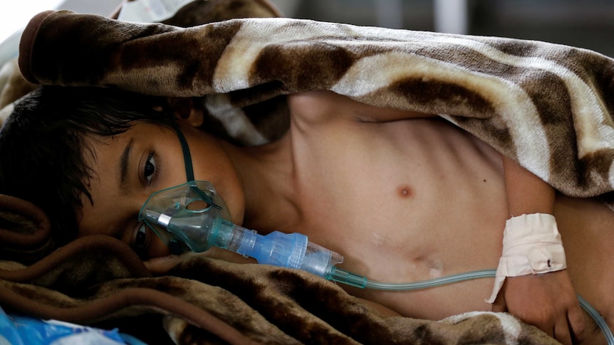 An eight-year-old malnourished boy lies on a bed in the emergency ward of a hospital in Sanaa, Yemen September 27, 2016.